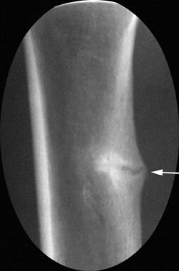 Magnified anteroposterior radiograph of the proxim