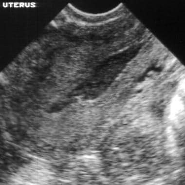 Endovaginal sonogram. This image shows a sagittal 