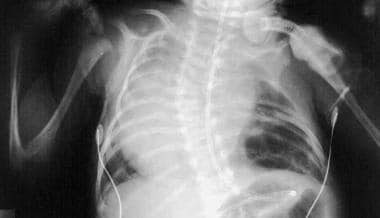 Anteroposterior radiograph of a patient with conge