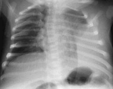 Supine chest radiograph in an infant. This image s