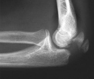 Olecranon avulsion fracture. Lateral view in a pat