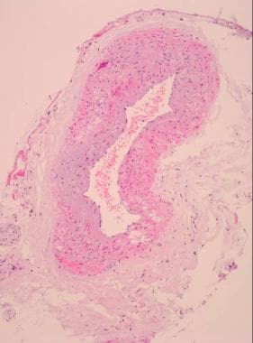 Giant cell arteritis. Low-power view of a normal t