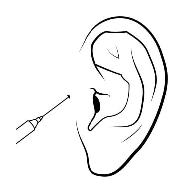 Technique to anesthetize the helix and tragus. 