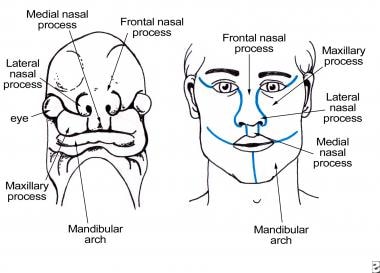 maxillary process