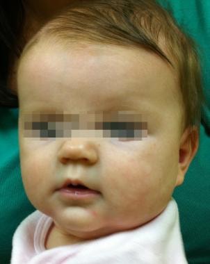 The same large hemangioma of infancy as in the pre