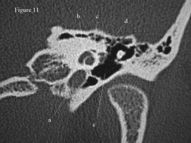 CT scan, temporal bone. The carotid artery (a) and