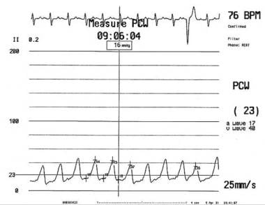 Tall V waves presented here on pulmonary arterial 