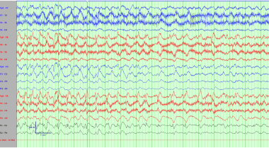 Electroencephalogram demonstrating a right frontal