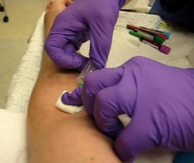 Phlebotomy. Removal of needle.
