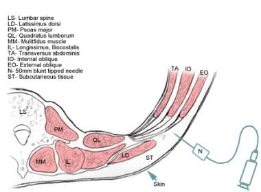 Cross-section of the abdominal wall layers. The TA