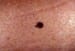 Melanocytic Nevi