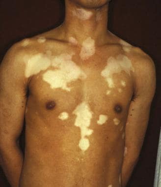 Trichrome vitiligo. 