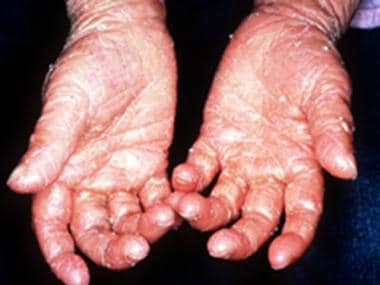 mild lamellar ichthyosis