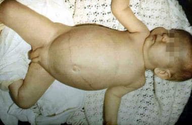 An infant with glycogen storage disease type Ia. N