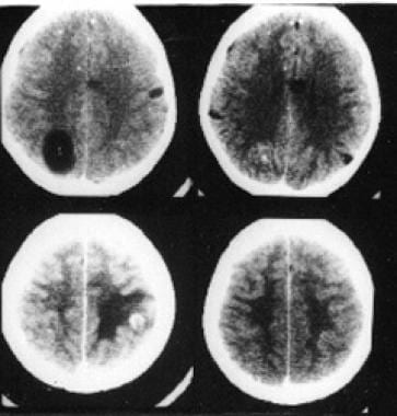 Neuroimaging in neurocysticercosis. Natural histor