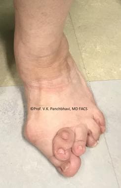 Severe hammertoe deformity in second toe overlappi