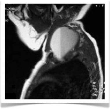 Sagittal T2-weighted MRI image of previously menti
