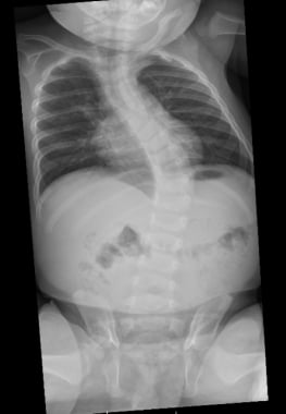 Treatments  iowascoliosis