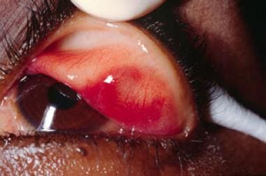 Chalazion with eyelid everted. Image courtesy of L