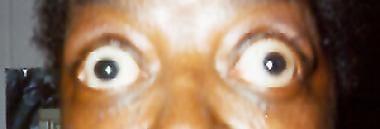 Bilateral exophthalmos and upper lid retraction se
