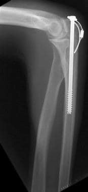 Lateral radiograph demonstrating threads of screw 