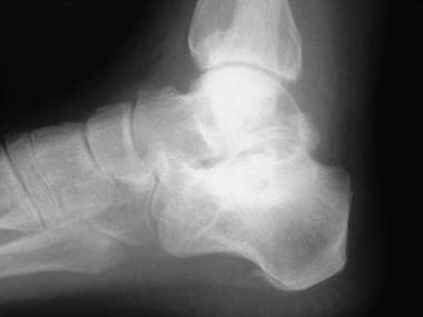 Osteophytes and degenerative joint disease easily 