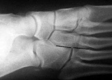 In this medial oblique radiograph of a normal foot