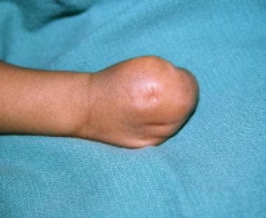 Apert syndrome (type III), dorsal view. 
