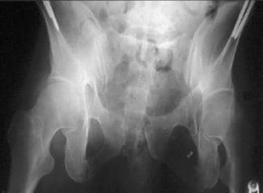 What are open book pelvic fractures?