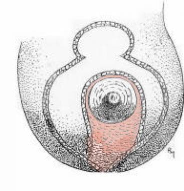 Designing the dermal inferior pedicle and its dis-