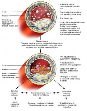 Unstable Angina: Practice Essentials, Background, Pathophysiology