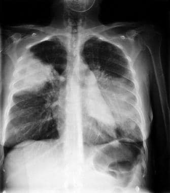 A 28-year-old woman who was a former intravenous d