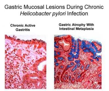 Helicobacter pylori–caused chronic active gastriti