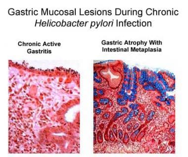 atrophic gastritis histology