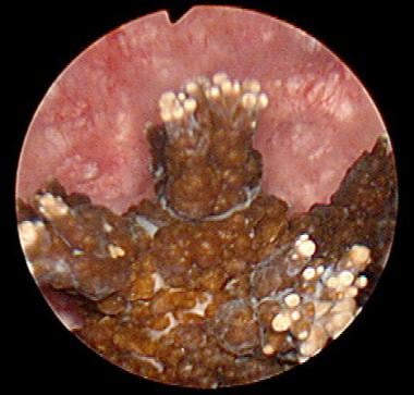 Endoscopic view of spiculated "jack" stone with er