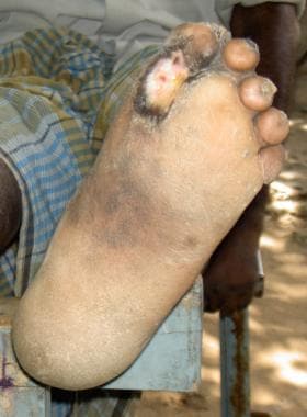 Chronic nonhealing ulcer at the metatarsal head re