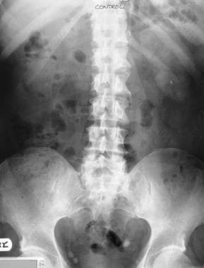 Plain kidney-ureter-bladder (KUB) radiograph in ma