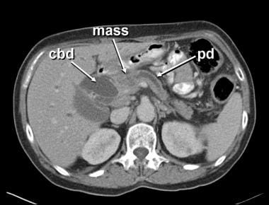 Pancreatic cancer. Abdominal CT scan of a small, v