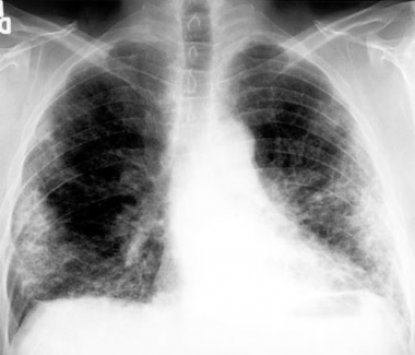 Chest radiograph of a 67-year-old man diagnosed wi