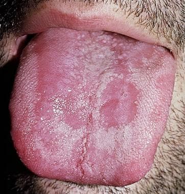 Plaques and erosions of tongue in patient with rea