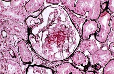 A renal biopsy specimen from a 13-year-old girl wi