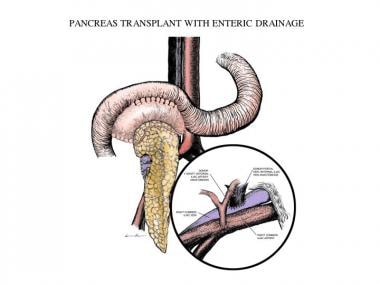 Solitary pancreas transplantation with enteric dra