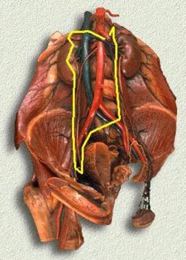 Full right-sided retroperitoneal lymph node dissec