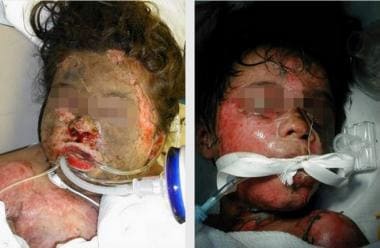 Smoke inhalation in pediatric victims. Note the ma
