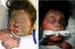 Smoke Inhalation Injury