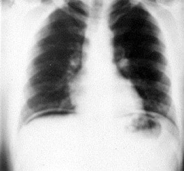 This chest radiograph demonstrates free air under 