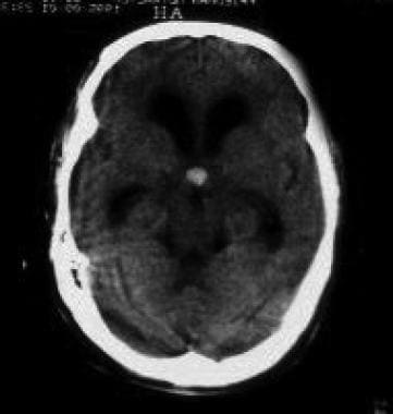 Brain neoplasms. Colloid cyst of the third ventric