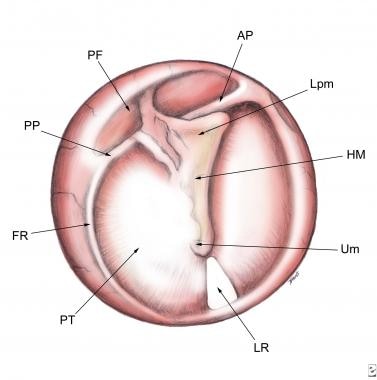 normal tympanic membrane vs bulging