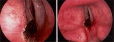 Direct laryngoscopic view of larynx after left pos
