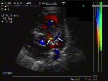 Two-dimensional echocardiographic image with color
